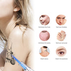 Tattoo Removal Laser Pen Skin Mole Freckle Acne Removal Device