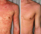 Eczema Relief Cream with Aloe Vera and Oats Skin Moisturizer Cream