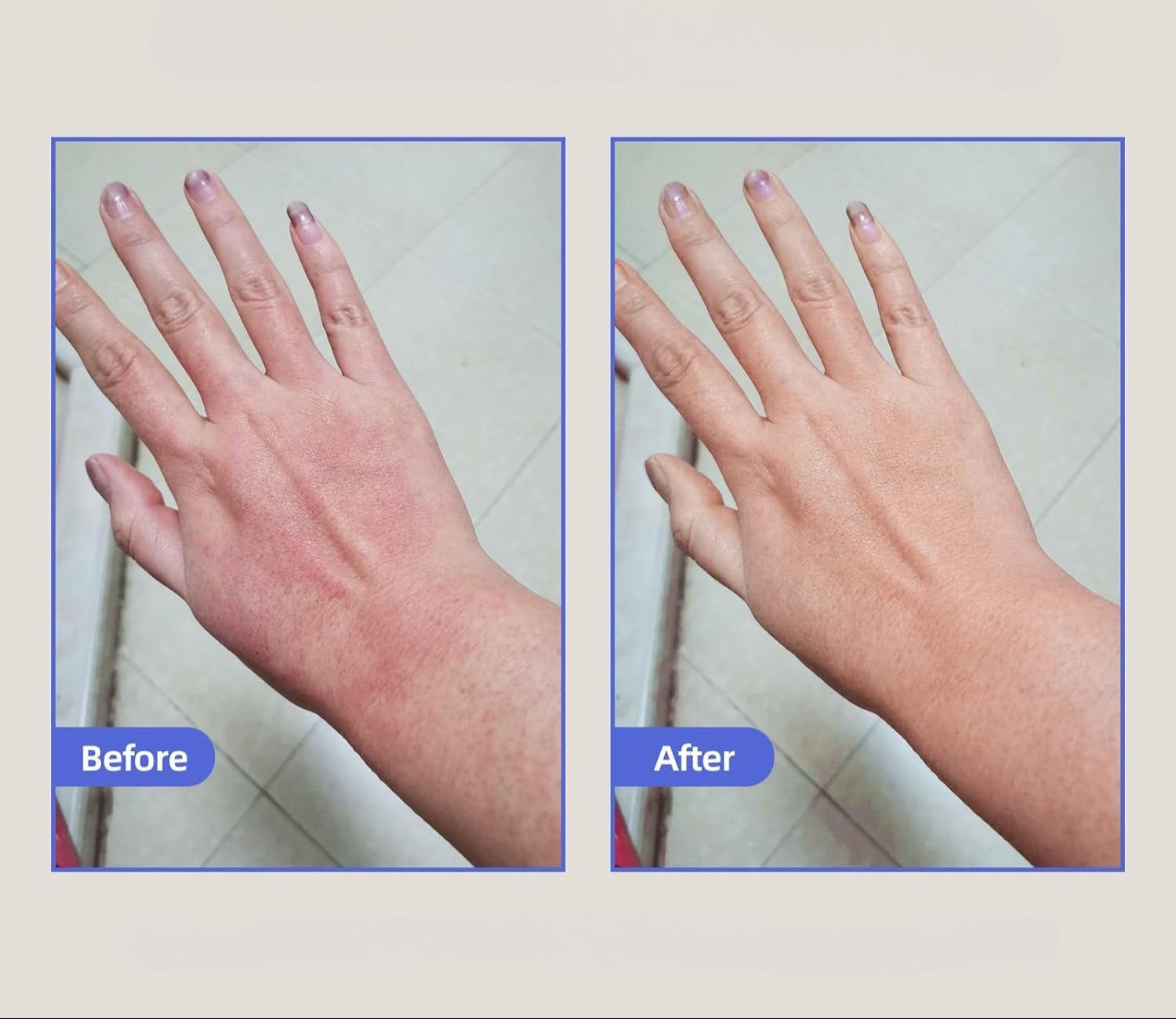 Eczema Relief Cream with Aloe Vera and Oats Skin Moisturizer Cream