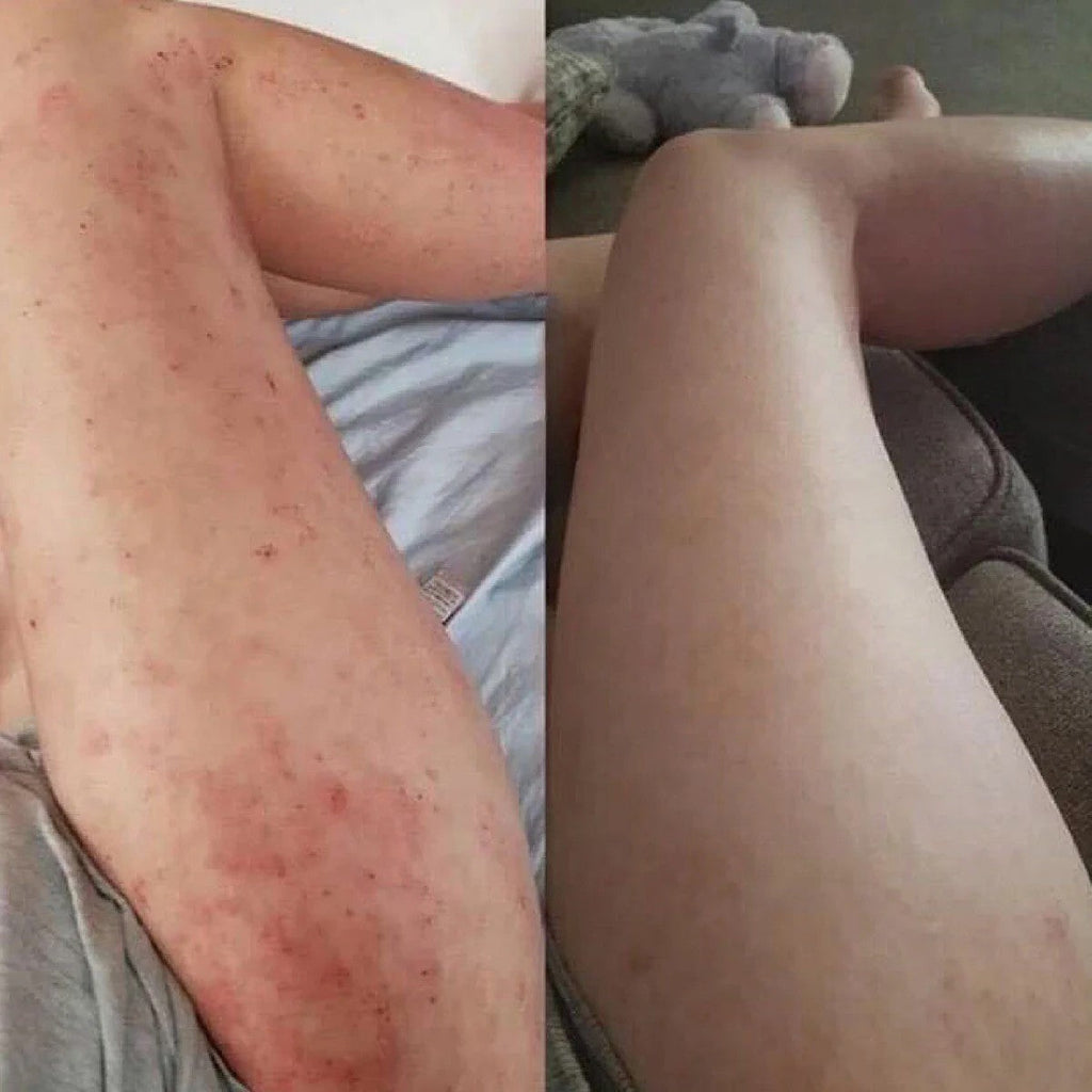 Eczema Relief Cream with Aloe Vera and Oats Skin Moisturizer Cream